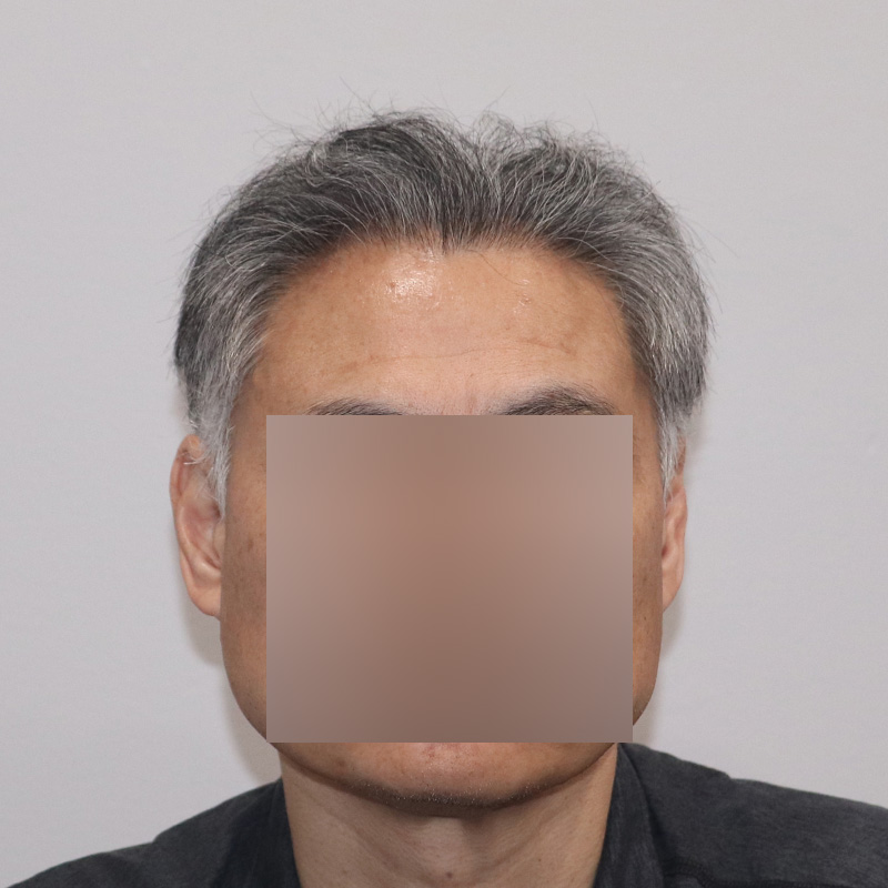 FUE hair transplant before and after results, 2284 grafts front - featured