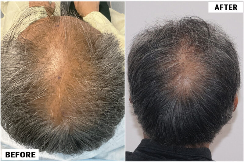 FUE hair transplant before and after results, 2284 grafts crown view