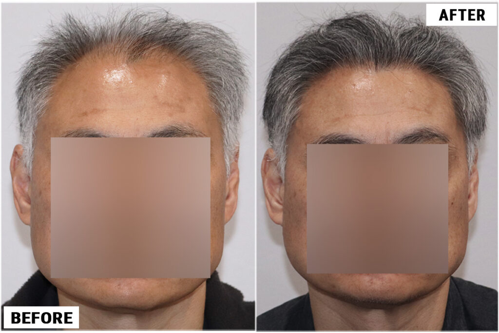 FUE hair transplant before and after results, 2284 grafts front - featured