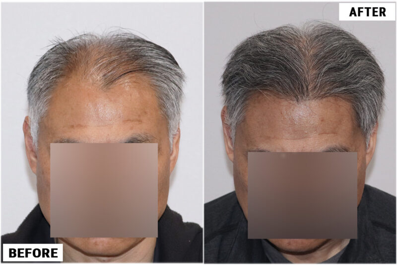 FUE hair transplant before and after results, 2284 grafts top 1
