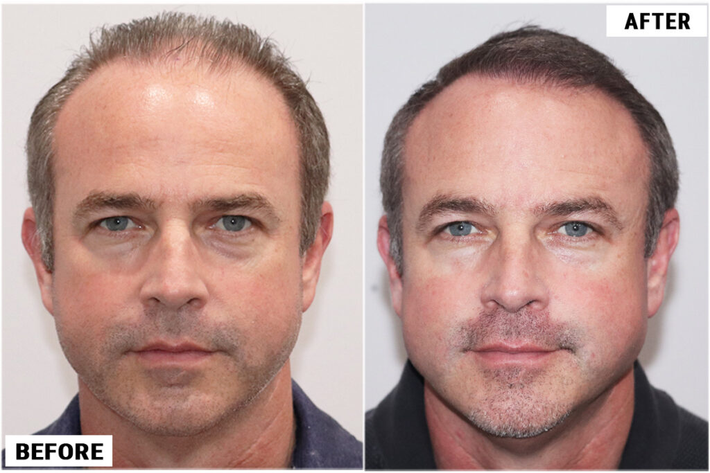 FUE hair restoration 4212 grafts - featured
