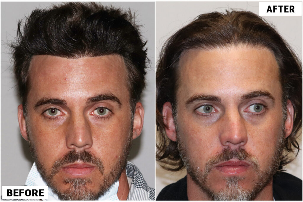 Hair tranlant hairline repair - before and after results front featured