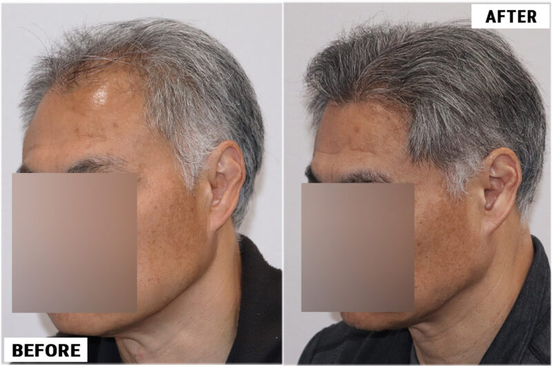 FUE hair transplant before and after results, 2284 grafts left