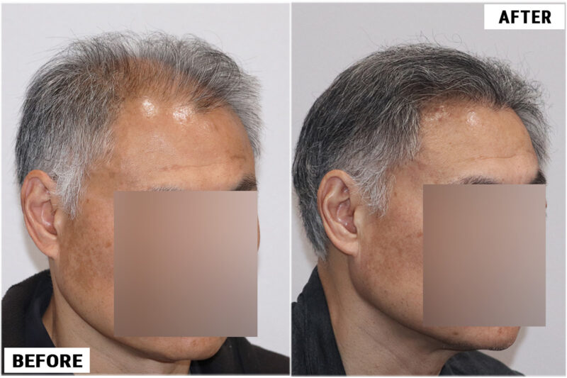 FUE hair transplant before and after results, 2284 grafts right side 1