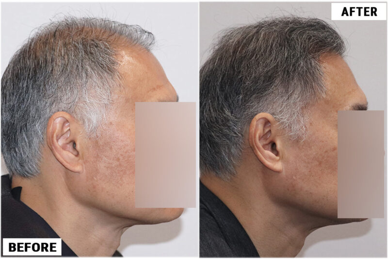 FUE hair transplant before and after results, 2284 grafts right side profile