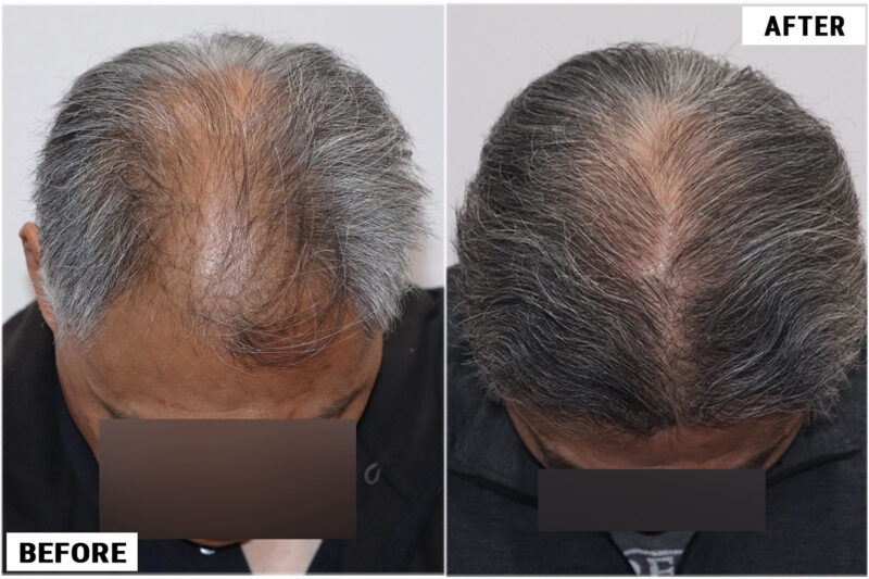 FUE hair transplant before and after results, 2284 grafts top 2