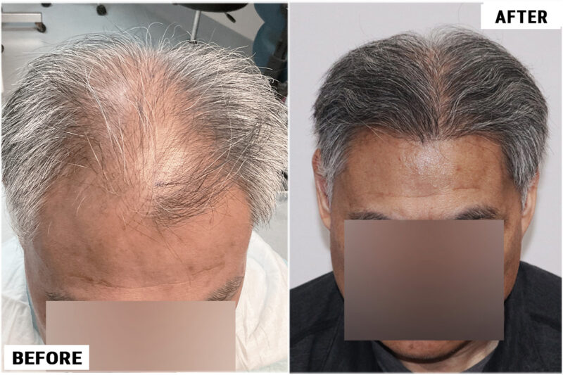 FUE hair transplant before surgery and after results, 2284 grafts top 3