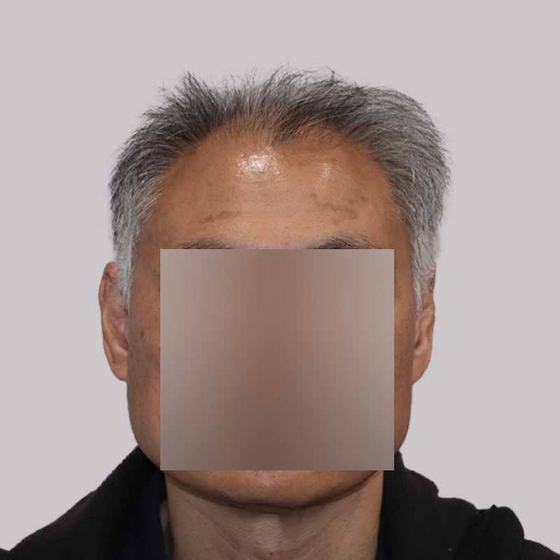 FUE hair transplant before and after results, 2284 grafts front - featured