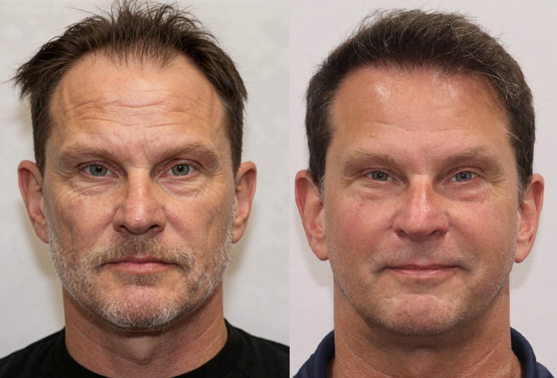 ForHair patient ״Michael McCalla״ Before and after review photo results