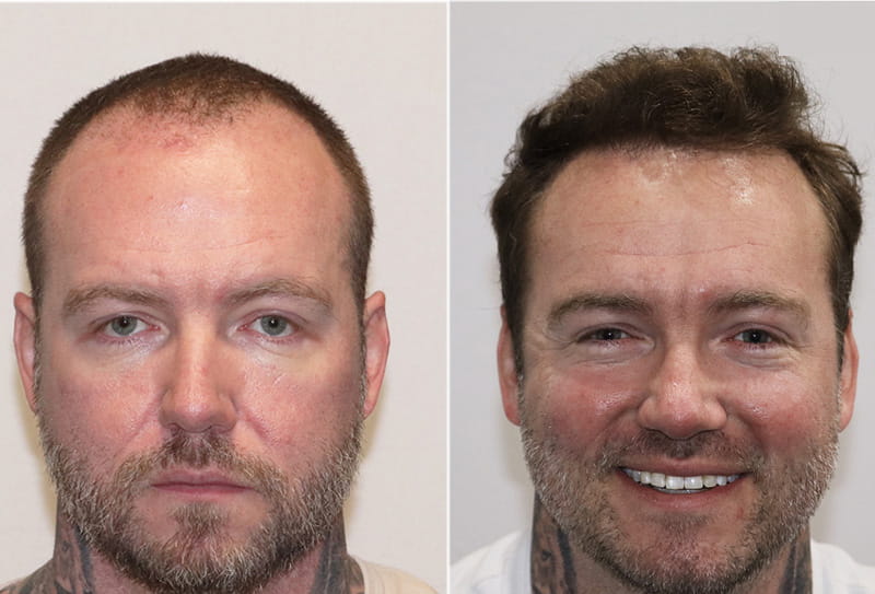 ForHair patient ״Chris Buckner״ Before and after review photo results
