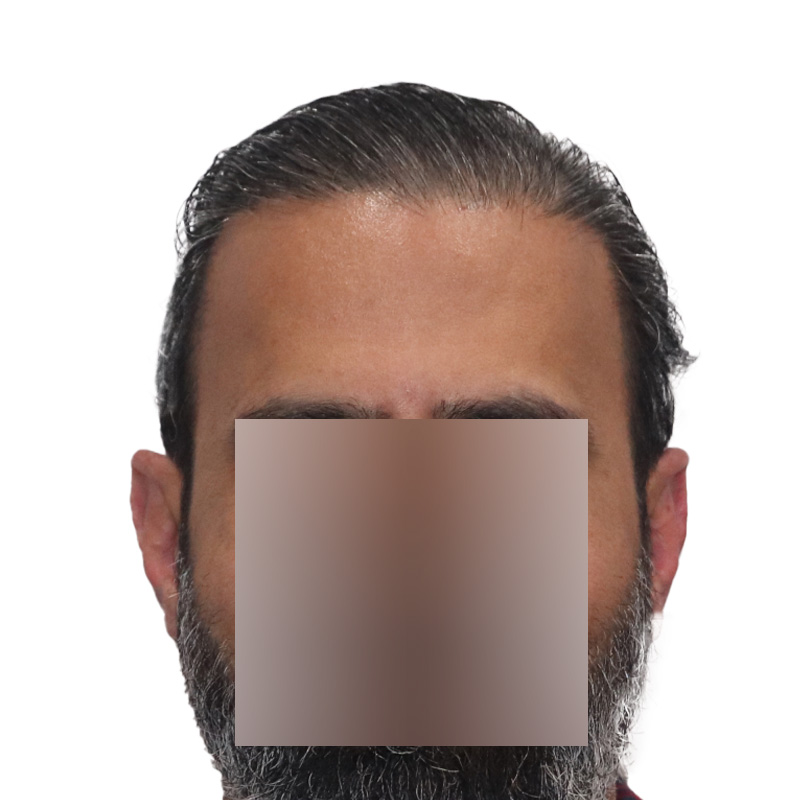 Hair Transplant 1897 grafts FUE - Featured