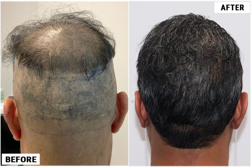 Hair Transplant 1897 grafts FUE - Back 2