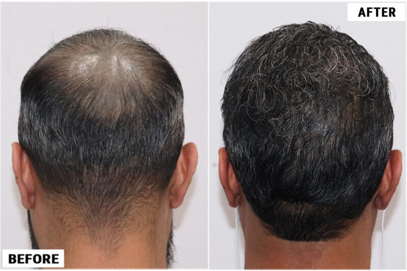 Hair Transplant 1897 grafts FUE - Back