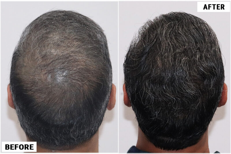 Hair Transplant 1897 grafts FUE - Crown