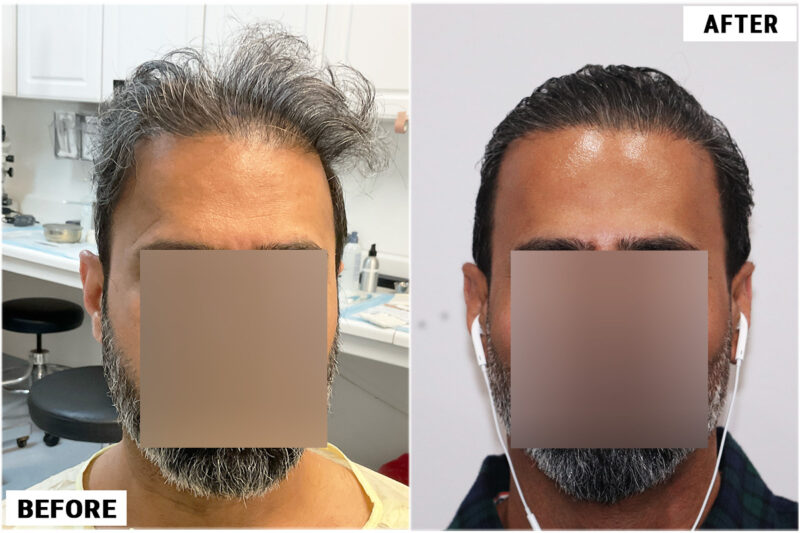 Hair Transplant 1897 grafts FUE - Front