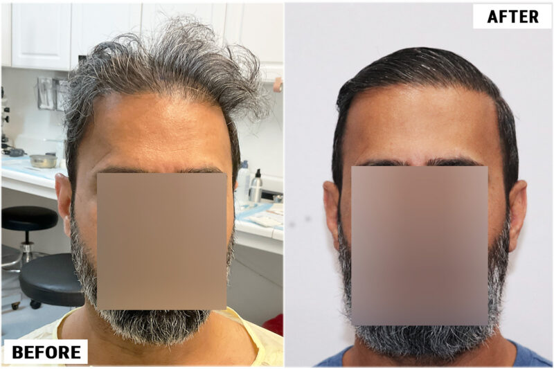 Hair Transplant 1897 grafts FUE - Front 2