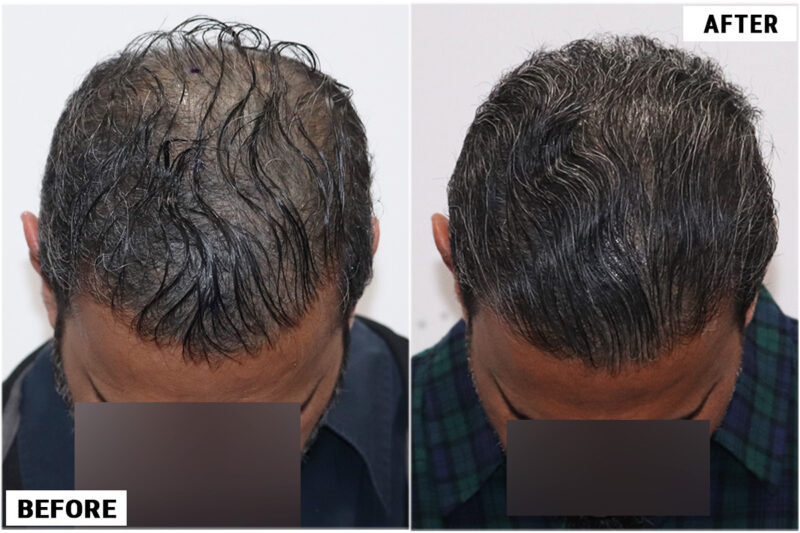 Hair Transplant 1897 grafts FUE - Top