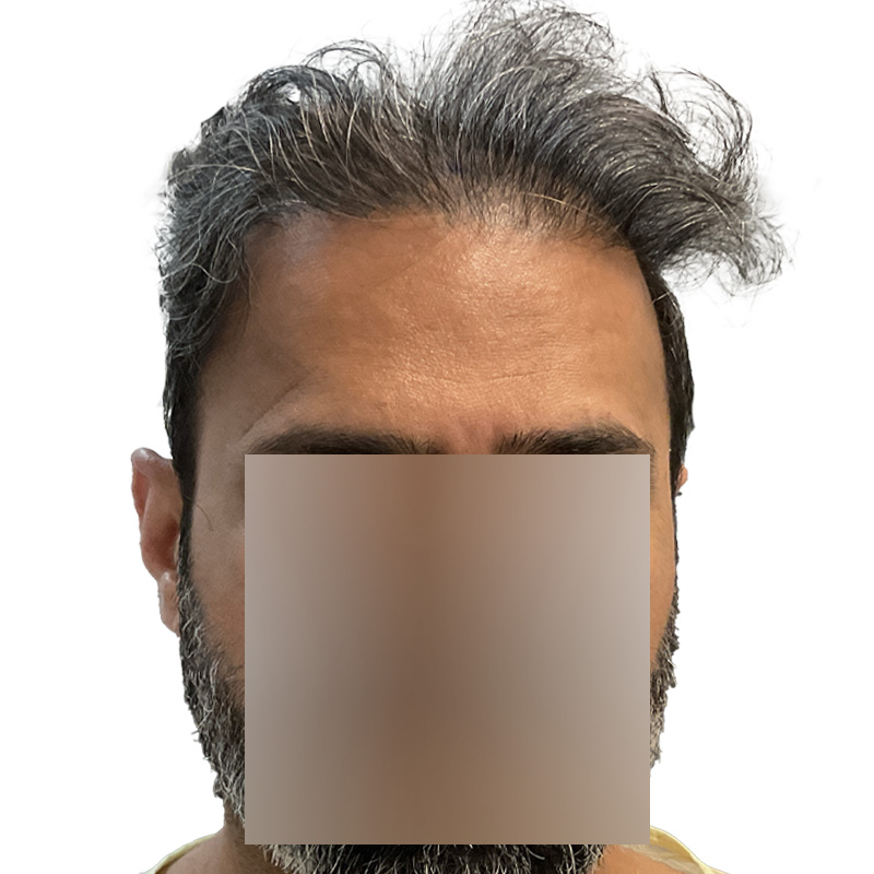 Hair Transplant 1897 grafts FUE - Featured