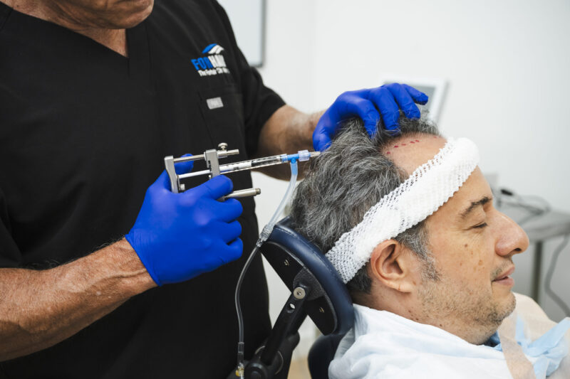 Forhair’s team performing a post hair transplant regenerative procedure on patient’s scalp.