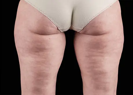 before reduction of cellulite Emtone