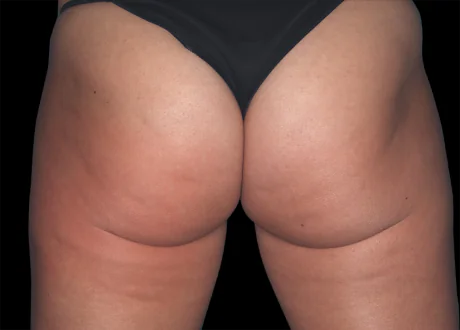 reduction of cellulite after Emtone