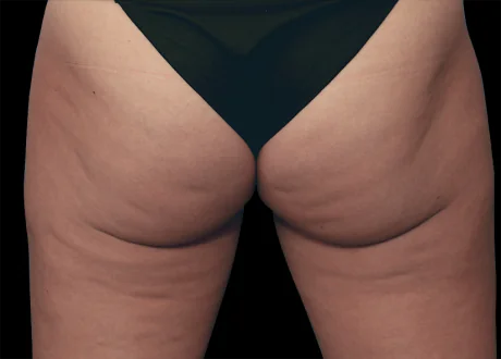 before reduction of cellulite Emtone