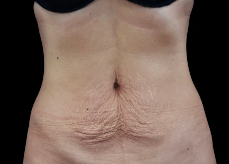 before reduction of cellulite Emtone